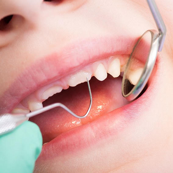 Closeup of dental mirror reflecting child’s still-growing teeth
