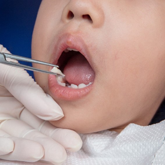 Child having a tooth extracted