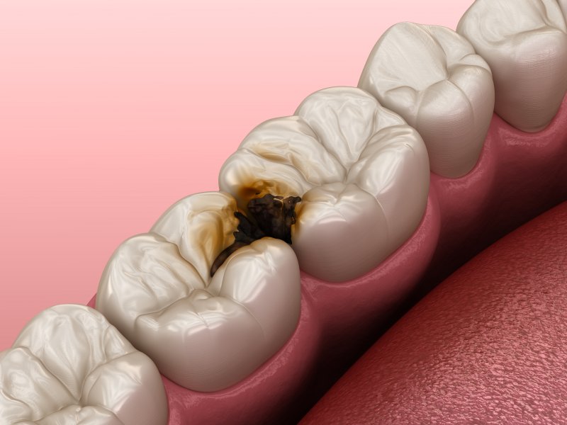 digital image of a cavity between two teeth